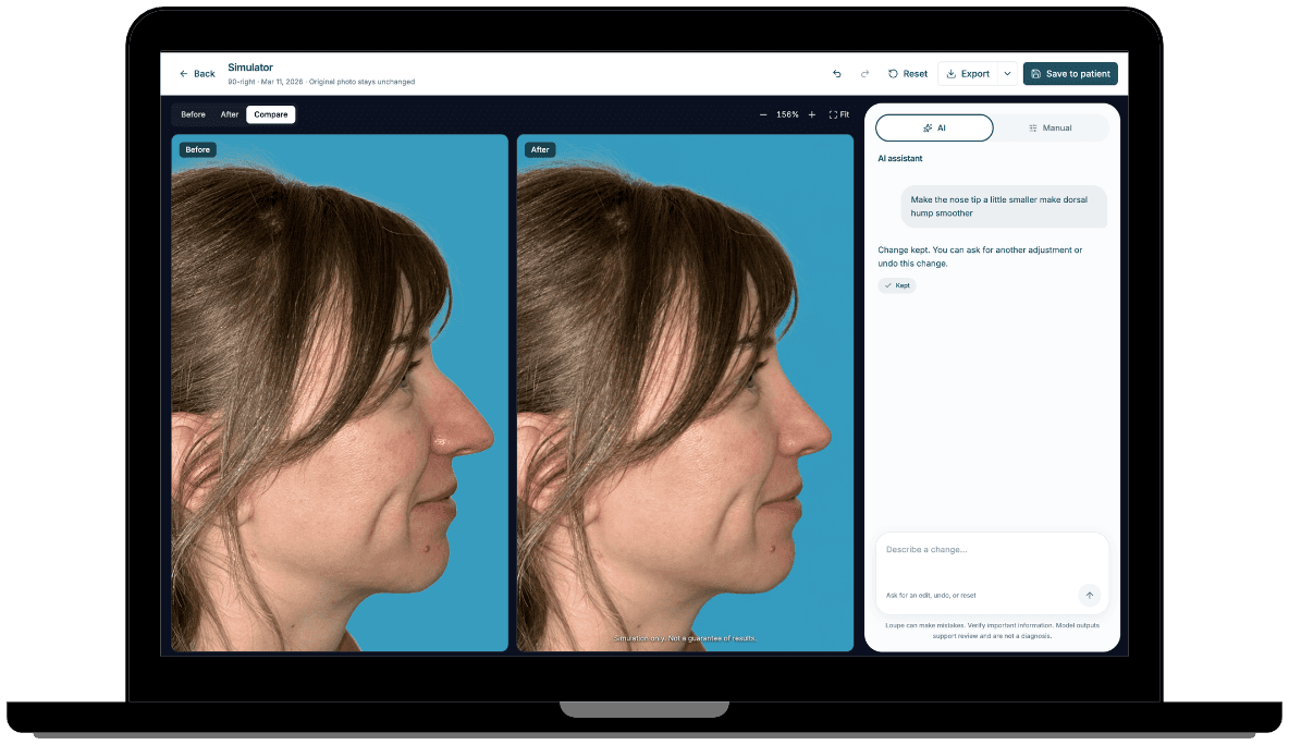 ImageAssist Simulator on a laptop: a patient's profile before and after a simulated nose refinement, with the Loupe assistant panel open
